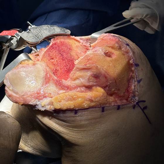 Caso real de artroplastia de rodilla 11