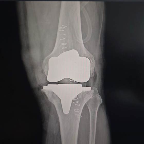 Caso real de artroplastia de rodilla 26